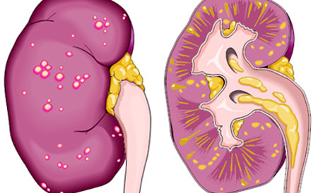 Diagnostic- Pielonefrită